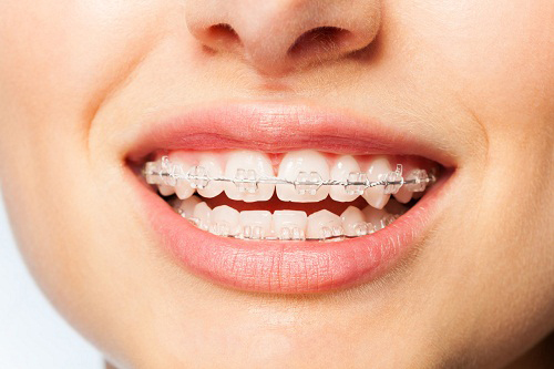 愛康健牙科牙齒不齊矯正要多久