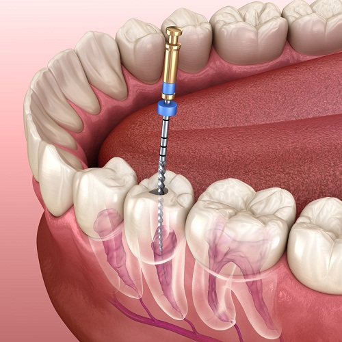 愛康健口腔牙齒根管治療全過程