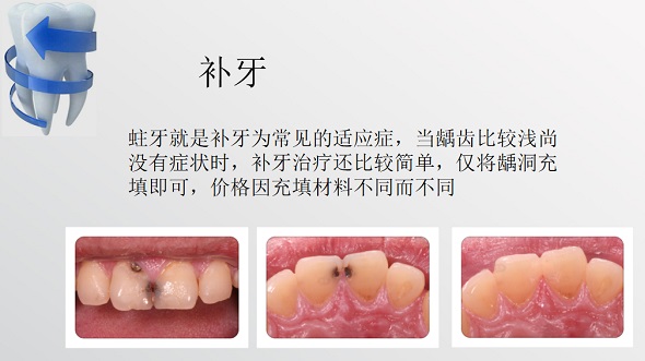 深圳愛康健補牙幾錢