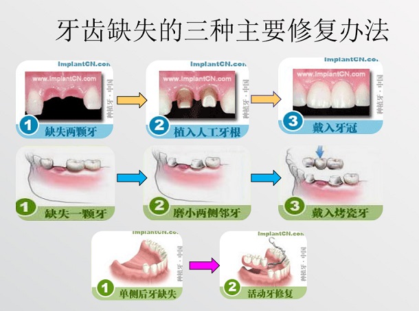 愛康健活動義齒價錢