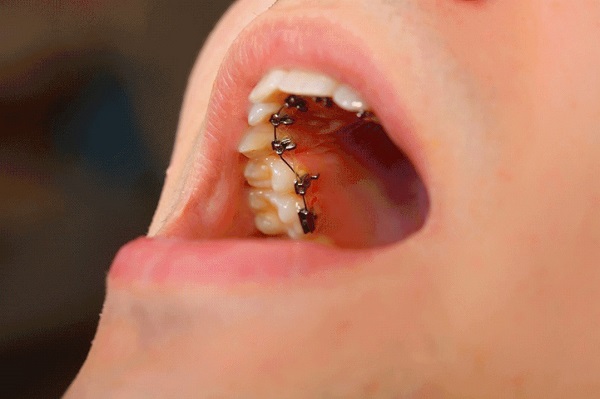 骨性齙牙能做矯正嗎