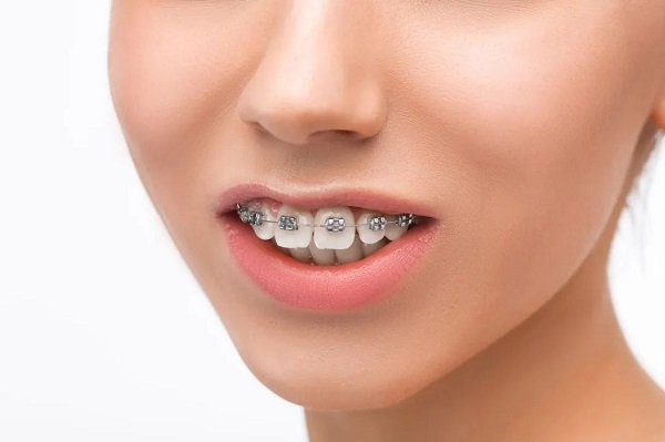 骨性齙牙嘴凸能通過牙齒矯正改善?骨性齙牙戴牙套有用嗎