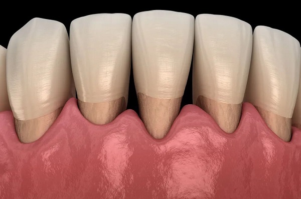 愛康健牙醫|牙齦萎縮到底怎麼回事