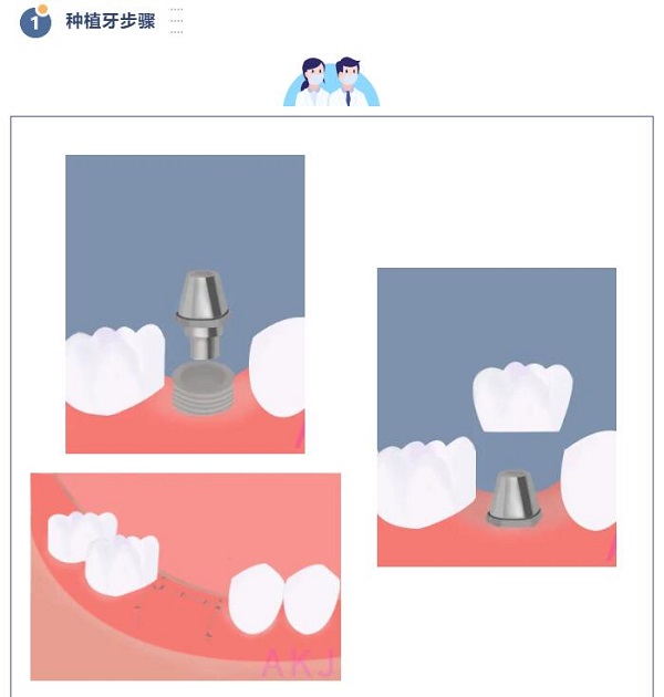 種植牙的流程及步驟