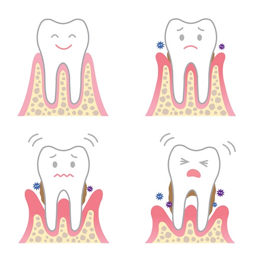 牙周病若不加以重視,嚴重的牙周會使你的牙齒掉光!