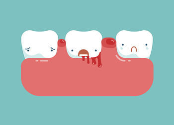 牙齦炎和牙周炎的區別!要怎麼治療