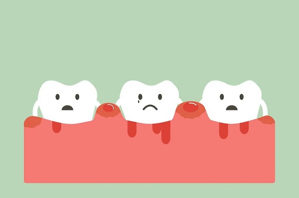 牙齦炎怎麼預防