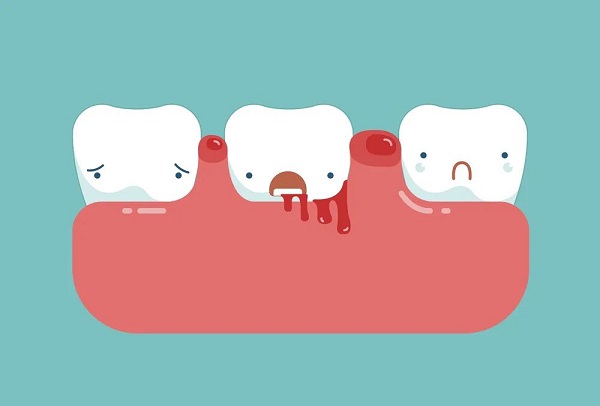 牙齦炎的癥狀有哪些