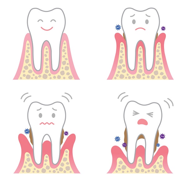 牙齒松動是什麼原因引起的