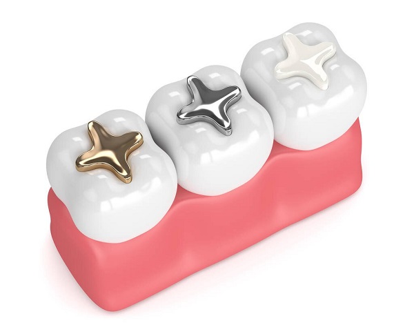 補牙用哪種材料比較好?深圳補牙價格是多少