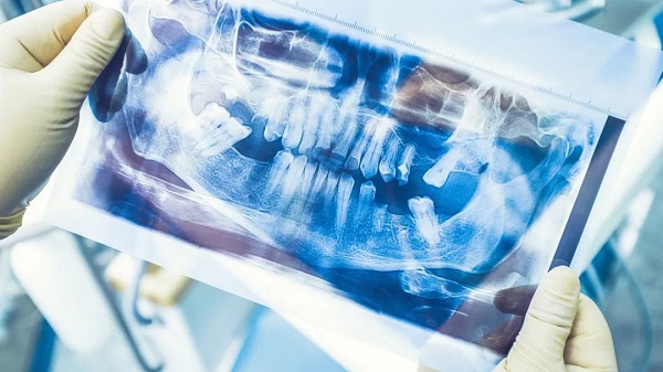 因牙周炎引起的牙齒缺失,還能做種植牙嗎