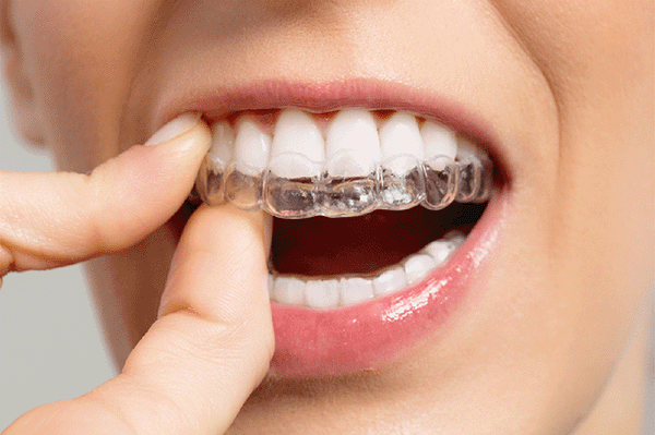 箍牙矯齒期間如何預防牙齦萎縮？