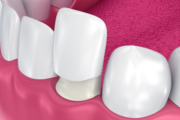 愛康健口腔醫院牙齒貼面怎麼收費?價錢是多少?