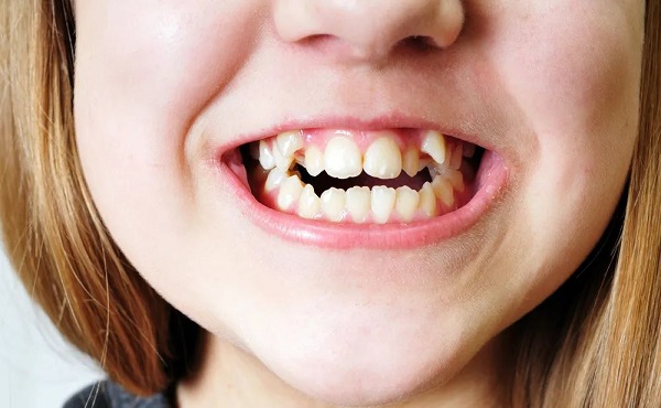 愛康健牙醫解析|兒童口腔不良習慣會有哪些影響