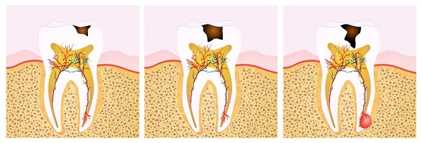 齲齒引發的牙髓炎