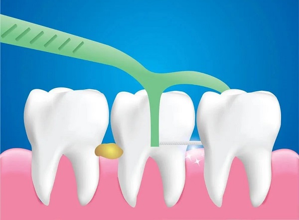 牙線會損傷牙齦嗎