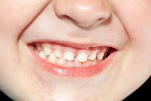 哪些牙齒問題需要做牙齒矯正