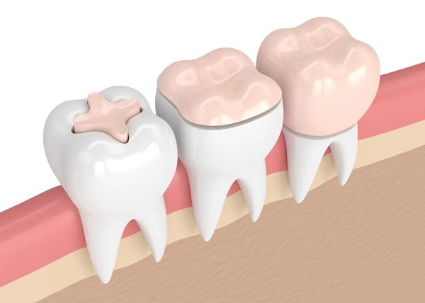 哪些牙齒問題適合做嵌體