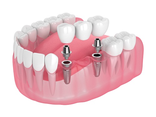 牙齒缺失的較佳修復方法?缺牙為什麼選做種植牙