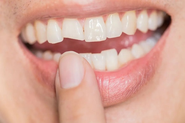 突發牙外傷該怎麼辦?常見的牙外傷有哪幾種？