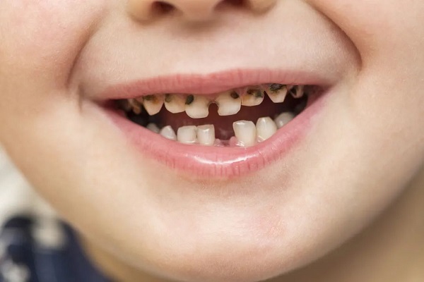 齲壞的乳牙長期不管,可能會導致孩子面部發育不對稱形成「大小臉」