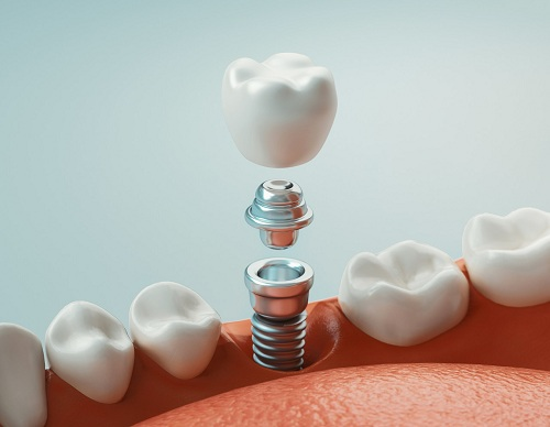 牙齒缺失後會帶來什麼影響,需要等多久才可以做種植牙？