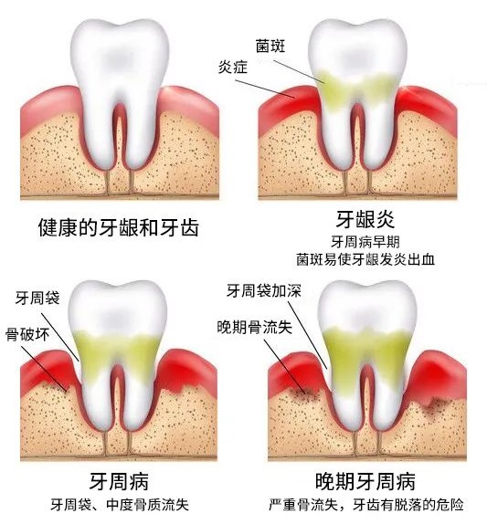 有牙周病還可以做牙齒矯正嗎