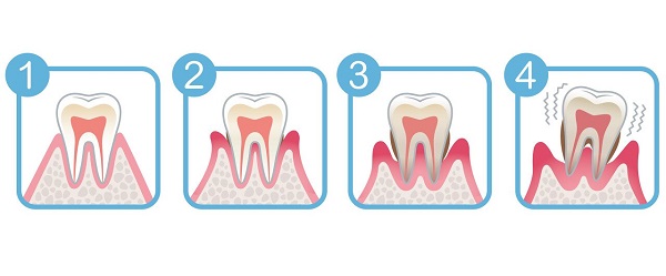 想問深圳愛康健牙科治療牙周病需要多少錢？