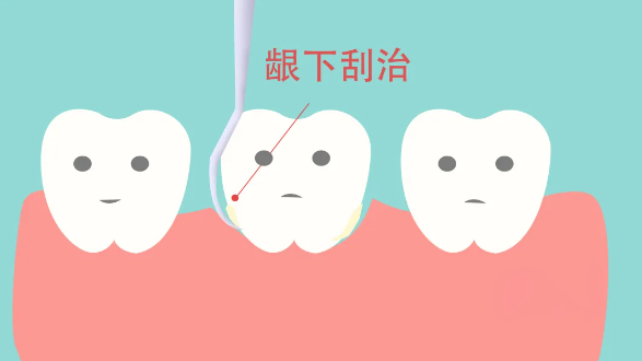 想問牙周炎做齦下刮治一般人受得住嗎？齦下刮治有必要嗎