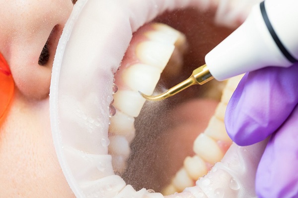 洗牙會不會傷到牙齒?為什麼洗牙時出現牙齦出血
