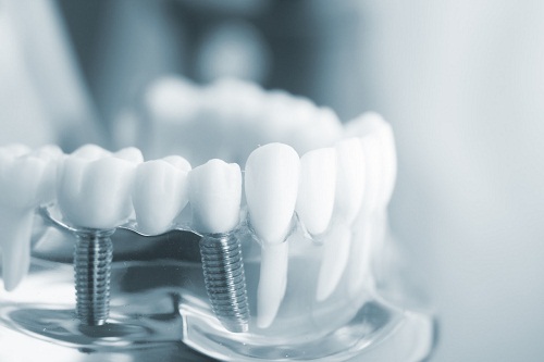 牙齒缺失不再是老年人的專利,20多歲也有做全口種植牙