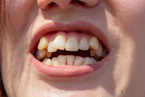 牙齒矯正一般拔哪些牙?深圳愛康健正畸繳納定金可參與3000-7000元矯牙減免活動