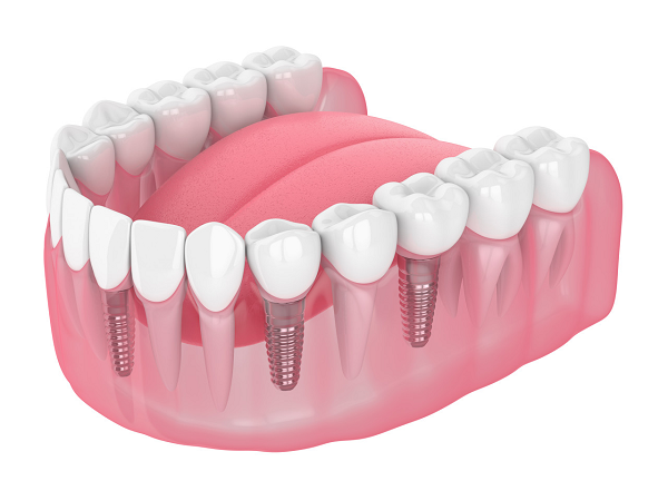 想問種牙和傳統鑲牙有什麼區別？