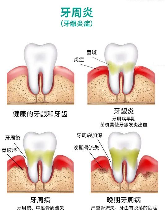 洗牙可以美白牙齒