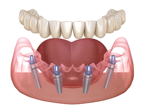 想問all-on-4即刻負重種植牙手術當天種牙當天就能用嗎？
