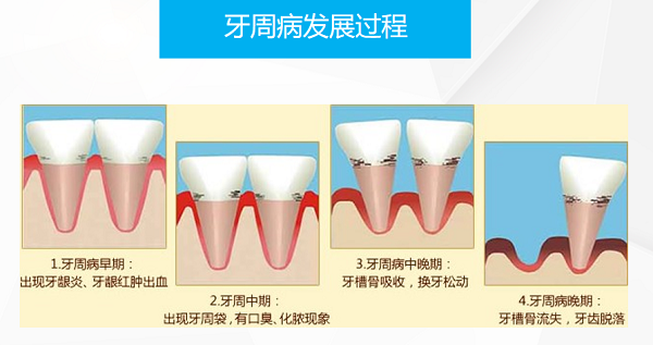 牙齒患有牙周炎怎麼治療?牙周炎有哪些手術治療方式
