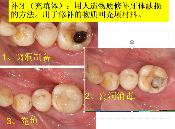 長者補牙可以使用醫療券嗎