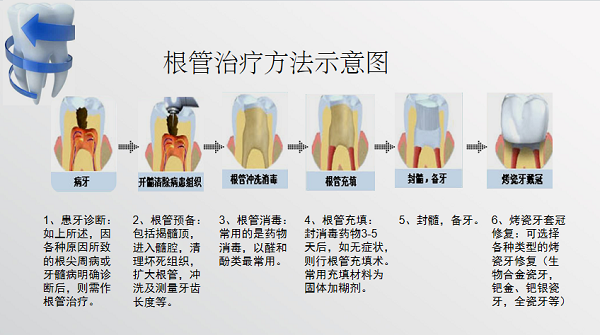 影響補牙價格的因素有哪些