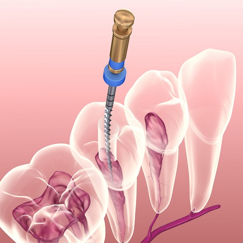 根管治疗0023.jpg