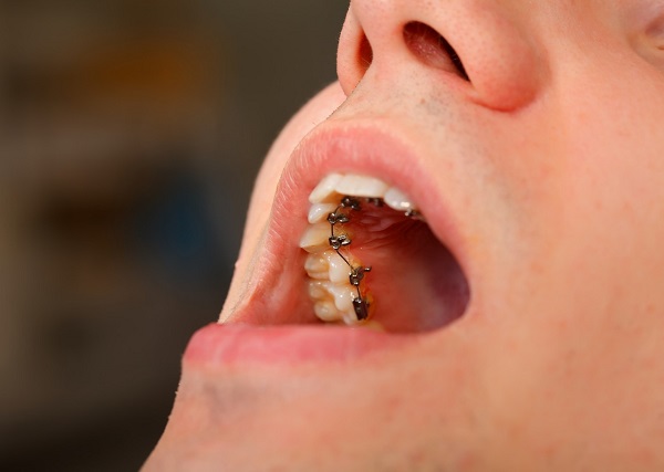 為什麼越來越多人選擇舌側矯正?深圳矯齒箍牙推薦愛康健牙科陸卉主任