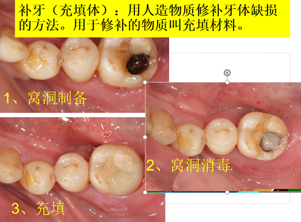 牙齒牙根發黑爛掉了怎麼治療?如何預防牙根發黑和腐爛?