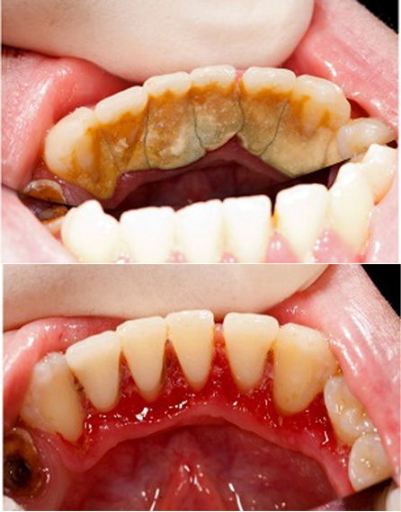 深圳洗牙多少錢