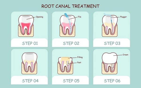 深圳根管治療費用