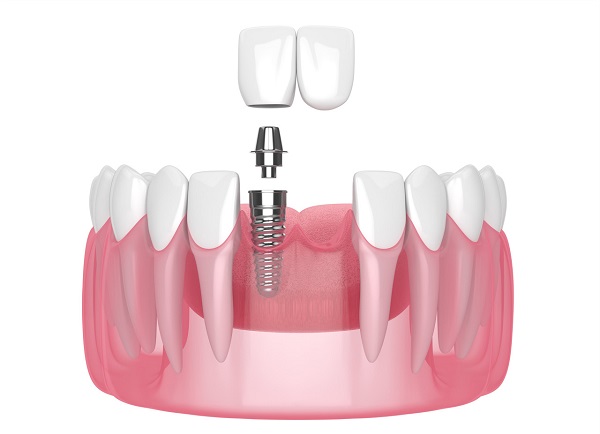 門牙種植牙多少錢一顆