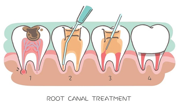根管治療後牙還疼是怎麼回事