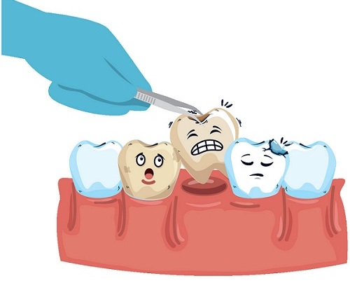 大牙爛了拔了好還是根管治療好