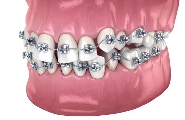 深圳金屬矯正牙套多少錢