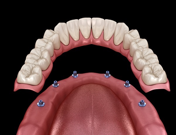 深圳種植牙價錢