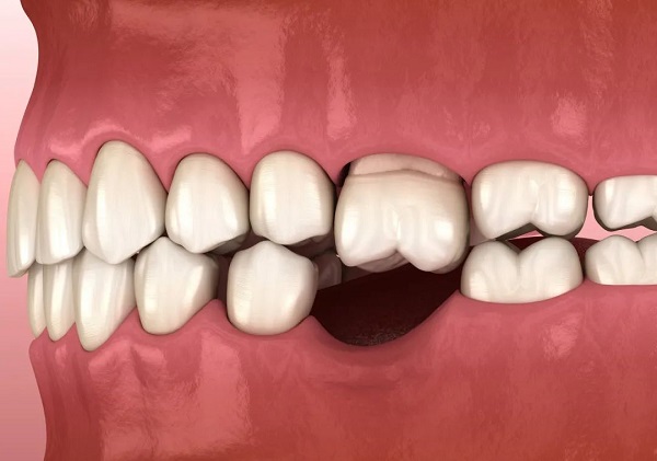 老人家大牙鬆想拔掉費用多少