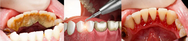 深圳洗牙去哪裡比較好